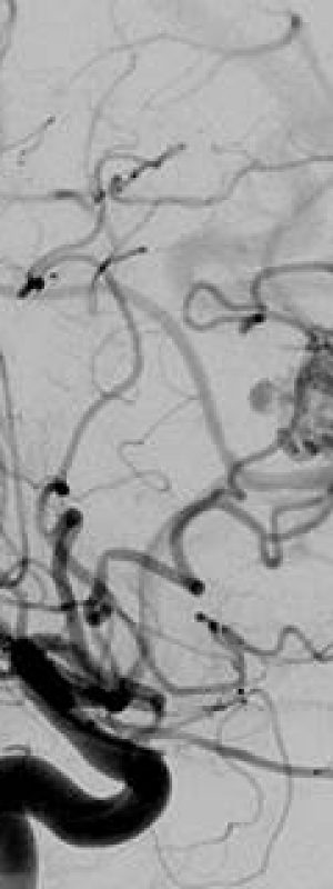 Hemorrhagic Stroke