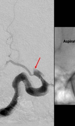 Ischemic Stroke